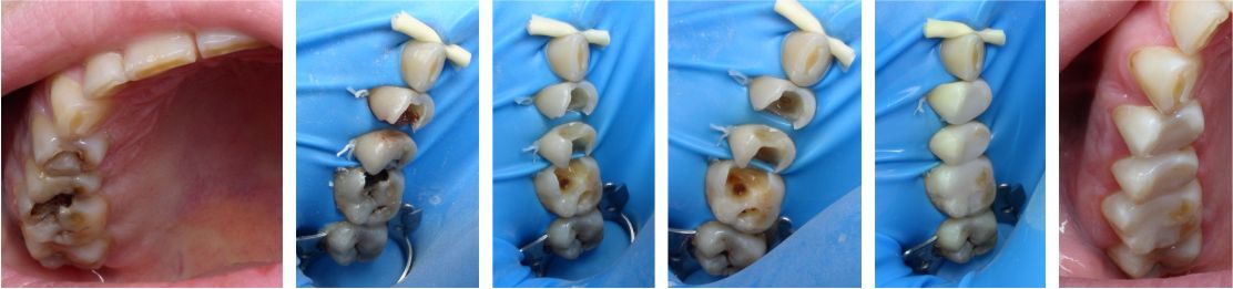 Реставрация зуба | Лечение зубов проводилось с использованием операционного стереомикроскопа Seiler Evolution XR6 | Лечение кариеса | Результат лечения зубов | Результат лечения - лучшая рекомендация для стоматолога