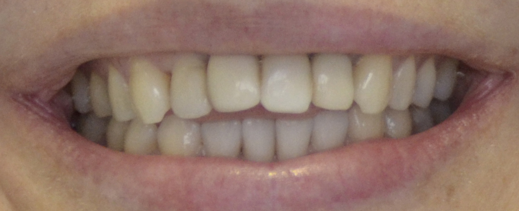 реставрация зубов - реставрация передних зубов - реставрация зубов до и после - эстетическая реставрация зубов - фото реставрация зубов - прямая реставрация зубов - реставрация фронтальных зубов - реставрация передних зубов фото