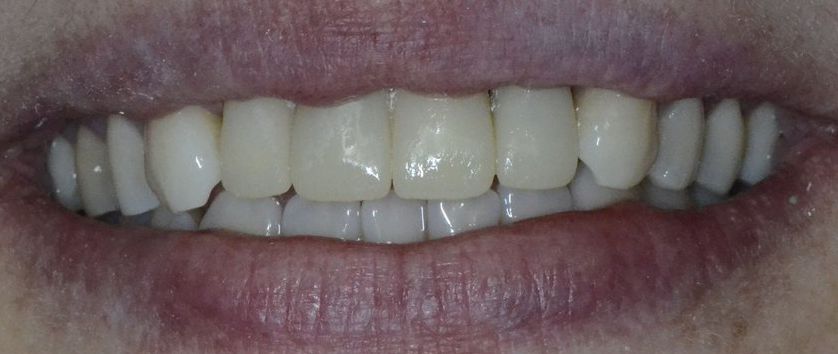 реставрация зубов - реставрация передних зубов - реставрация зубов до и после - эстетическая реставрация зубов - фото реставрация зубов - прямая реставрация зубов - реставрация фронтальных зубов - реставрация передних зубов фото