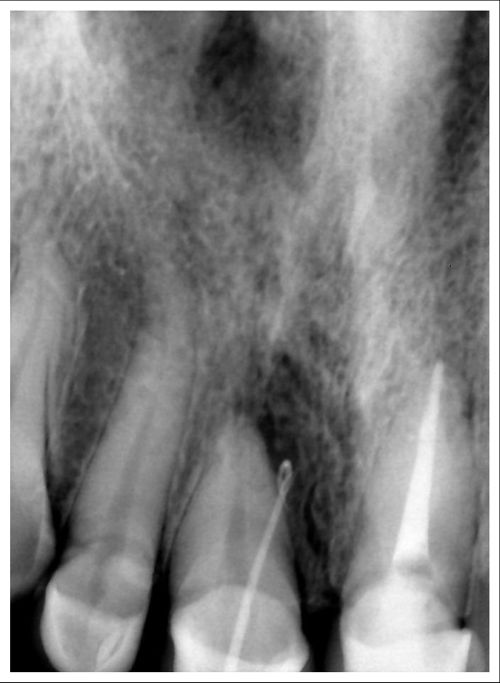 Периодонтит зуба | Стоматологическая клиника, профессиональное лечение зубов | Лечение зубов | Стоматолог Киев 